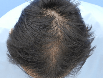 薄毛タイプ：O型 年齢：38歳 職業：事務職 治療期間：1年