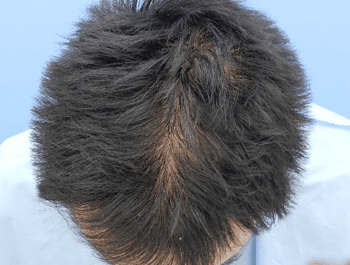 薄毛タイプ：O型 年齢：38歳 職業：事務職 治療期間：1年