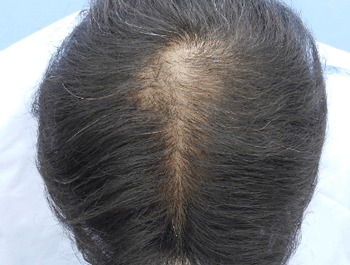 薄毛タイプ：O型 年齢：39歳 職業：会社員 治療期間：1年