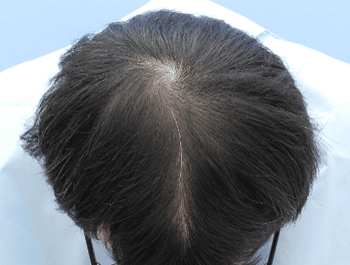 薄毛タイプ：O型 年齢：39歳 職業：会社員 治療期間：1年