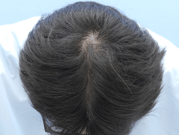 薄毛タイプ：O型 年齢：39歳 職業：会社員 治療期間：1年