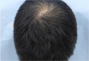 30代 O型 5か月後