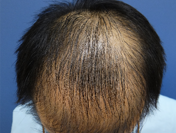 32歳/MO型/薄毛歴10年
