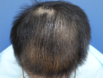 32歳/MO型/薄毛歴10年