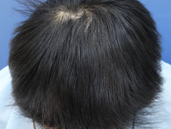 32歳/MO型/薄毛歴10年