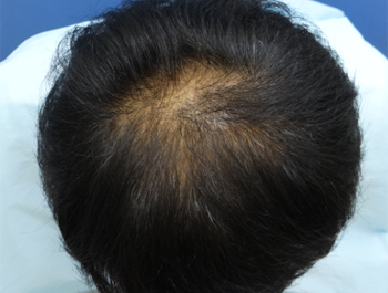 39歳/O型/薄毛歴4年/公務員