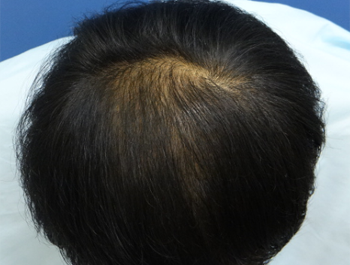 39歳/O型/薄毛歴4年/公務員