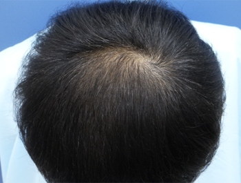39歳/O型/薄毛歴4年/公務員