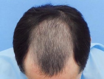 46歳/MO型/薄毛歴14年/会社員