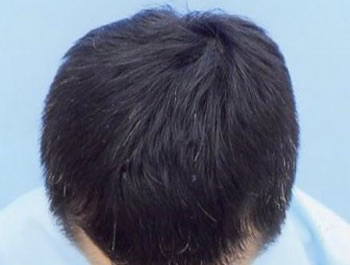 46歳/MO型/薄毛歴14年/会社員
