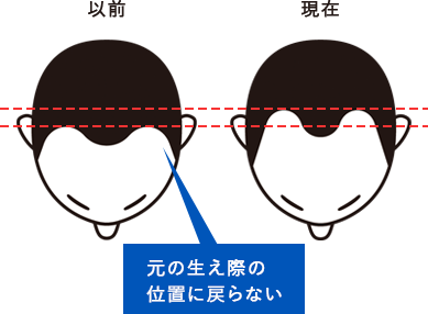 生え際