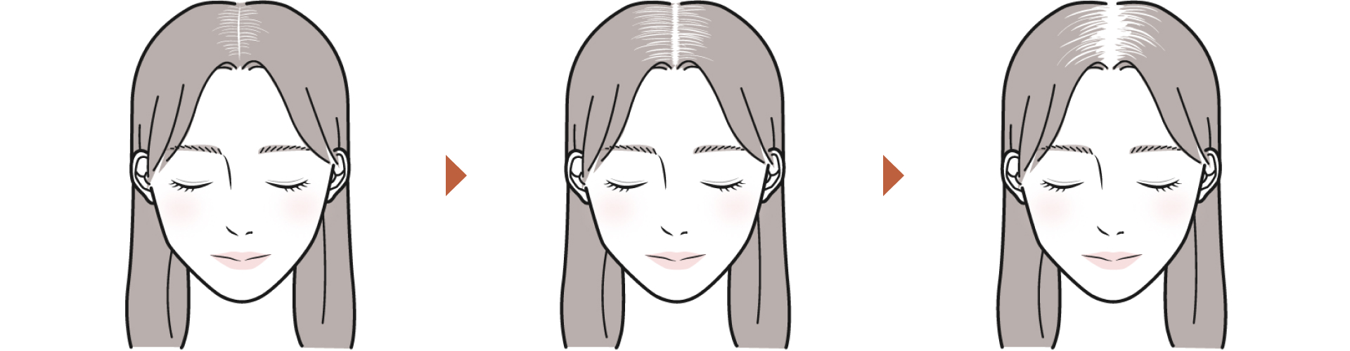 女性の男性型脱毛症(FAGA)