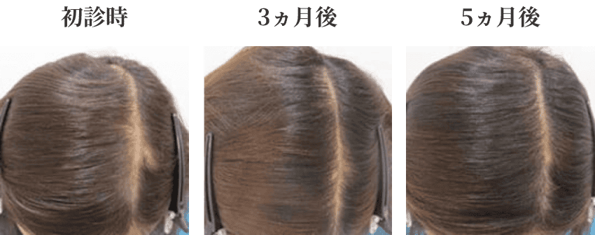 40代女性のミノキシジル外用治療症例