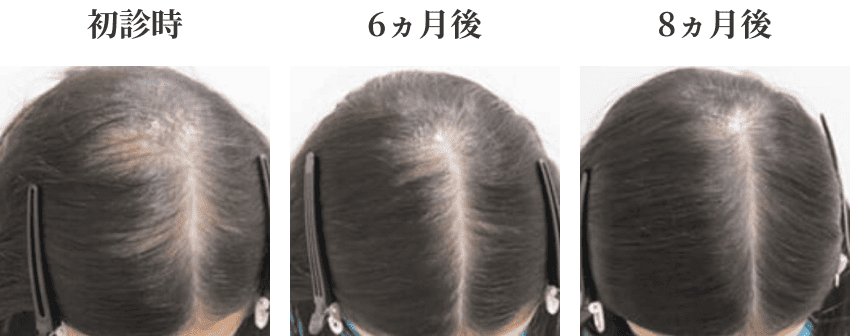 20代女性のミノキシジル外用治療症例