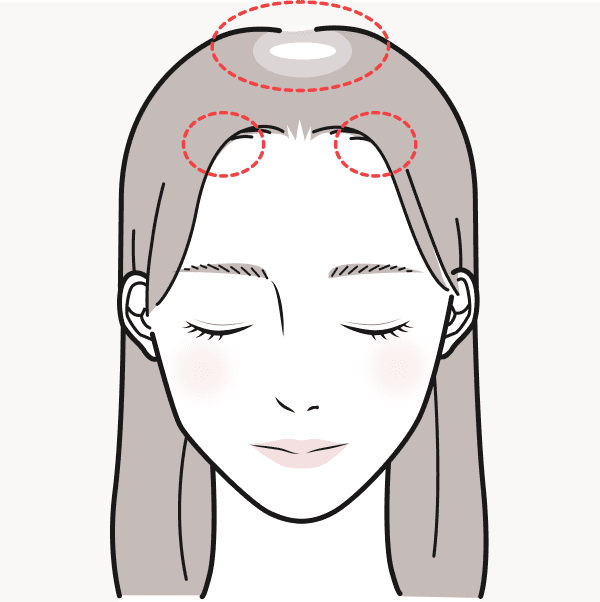 FAGAの症状に悩む女性