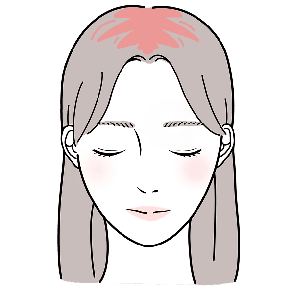 しろうせい脱毛症に悩む女性